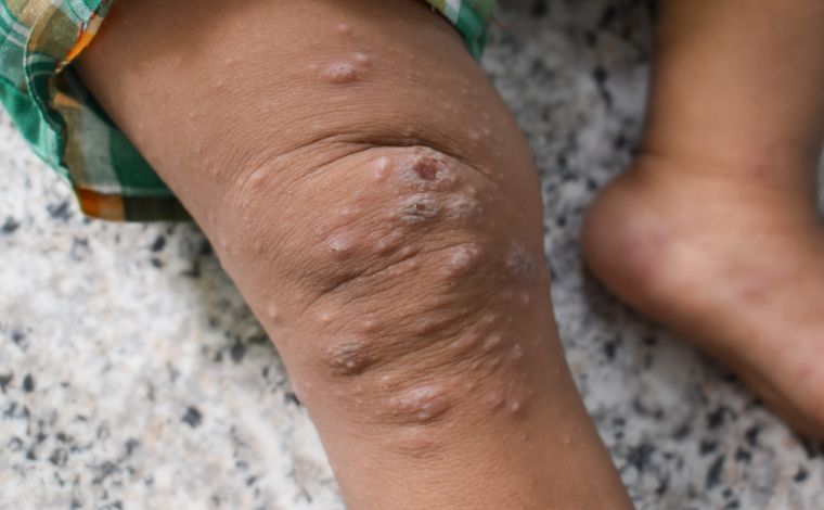 Mpox: Brasil tem média de 40 a 50 novos casos por mês; saiba o que é e como é transmitida